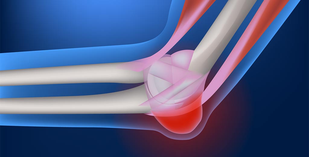 Schleimbeutelentfernungen beim Stuttgarter Orthopäden