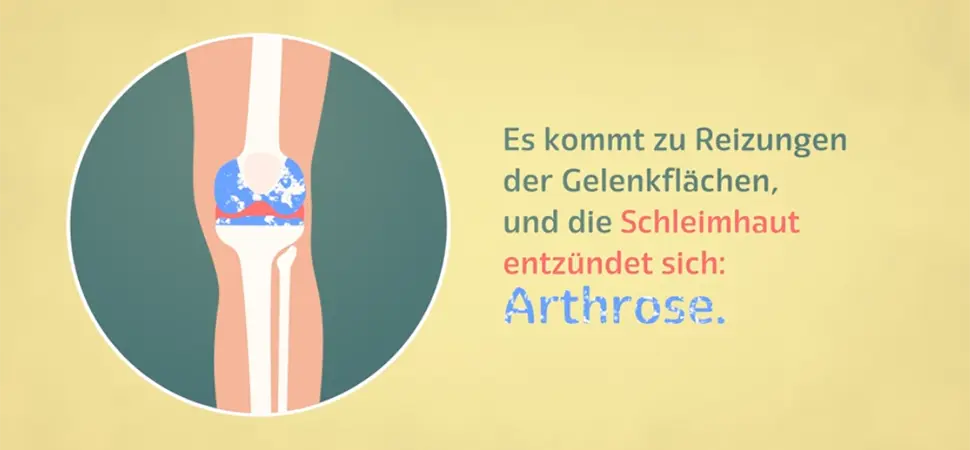 Arthrose Hyaluronsäure Orthopädie Stuttgart